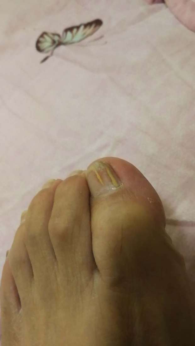 脚指甲纹是什么原因