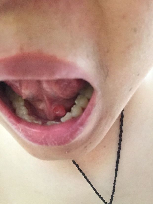 舌头下面先是长了个小肉芽,过几天变成了个肉球,不痛不痒.