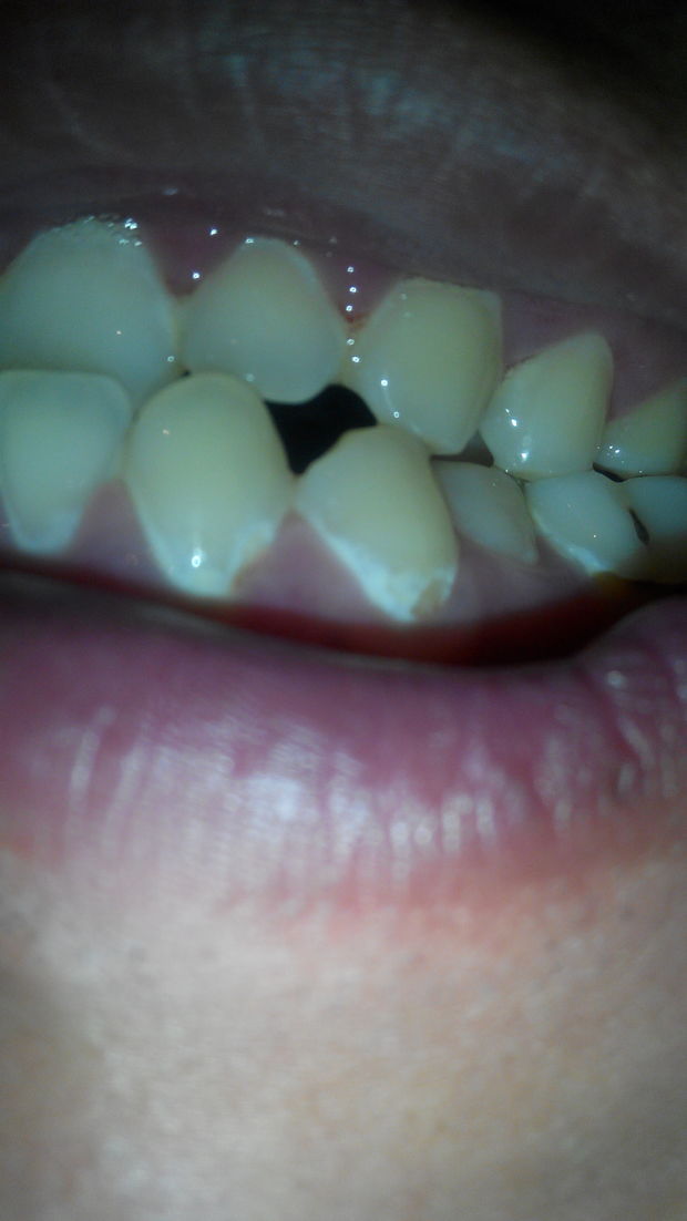 我的牙根烂了牙根部裂缝烂掉了,我这是什么病?怎么治疗?