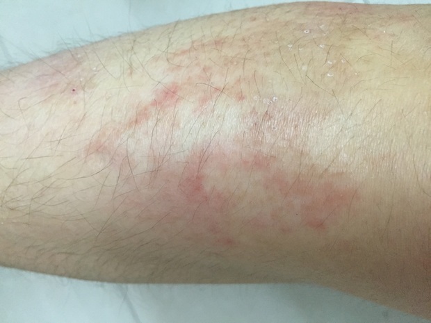 冬季小腿瘙痒怎么办