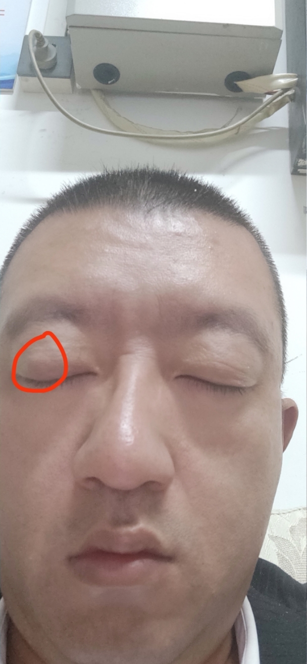 眼皮里长了个硬疙瘩