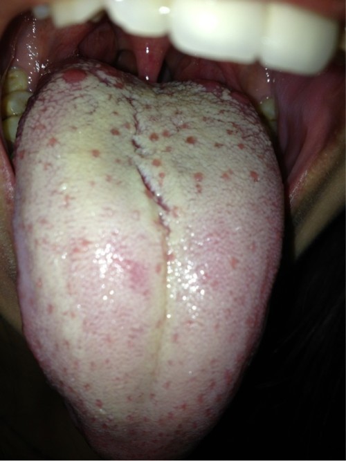 这个舌头根部红有裂纹有小泡具体是什么症状,脾胃不好