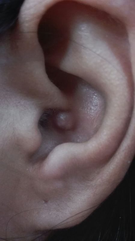 耳朵里长了一粒痘痘 你知道这是什么吗?