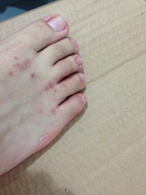 请问脚上突然长水痘一样的东西,还掉皮,有办法能解决吗