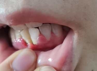 牙龈肿大 牙充血是不是牙周炎