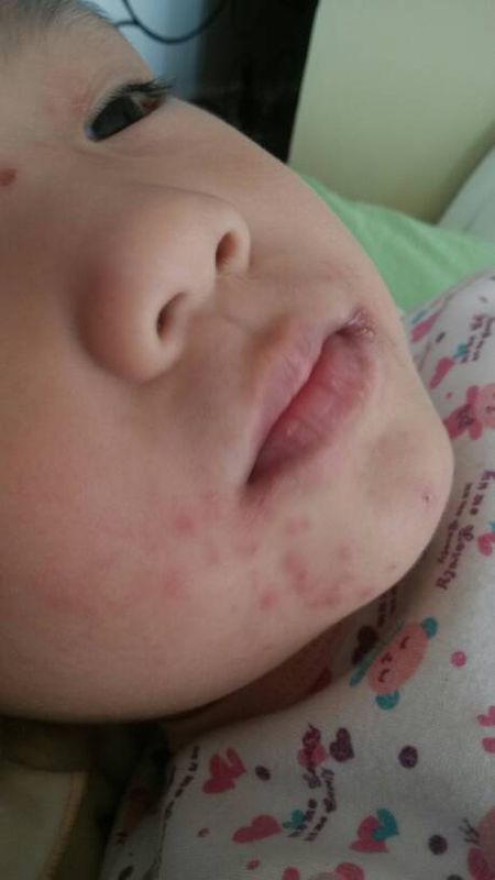 三岁孩子脸上过敏,长的红色小痘痘