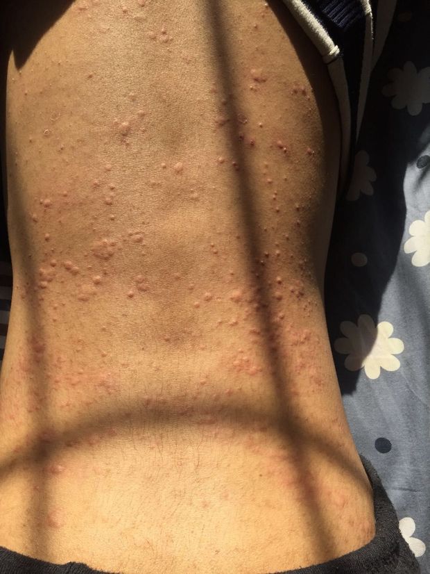 这是荨麻疹吗?为什么后背上的跟手臂上的不一样?
