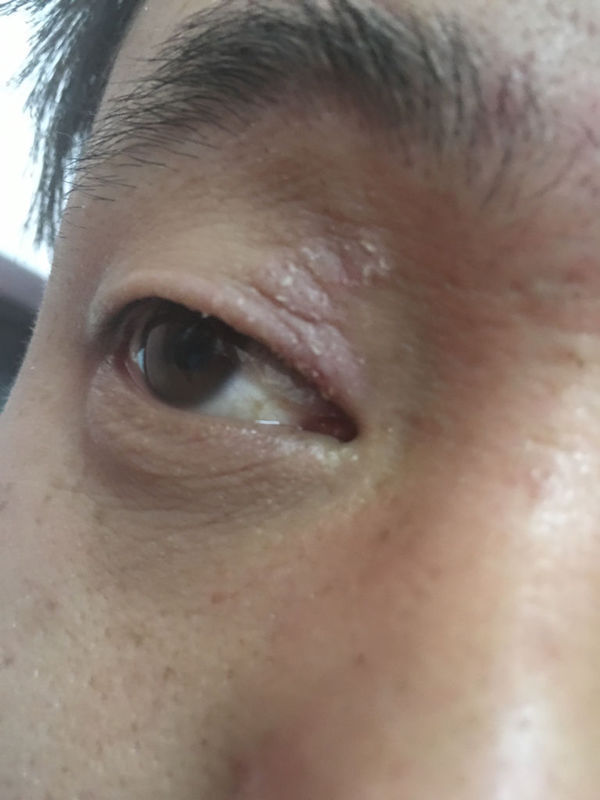 皮肤科专家看看我眼睛上眼皮一直出癣,已经有4五年了