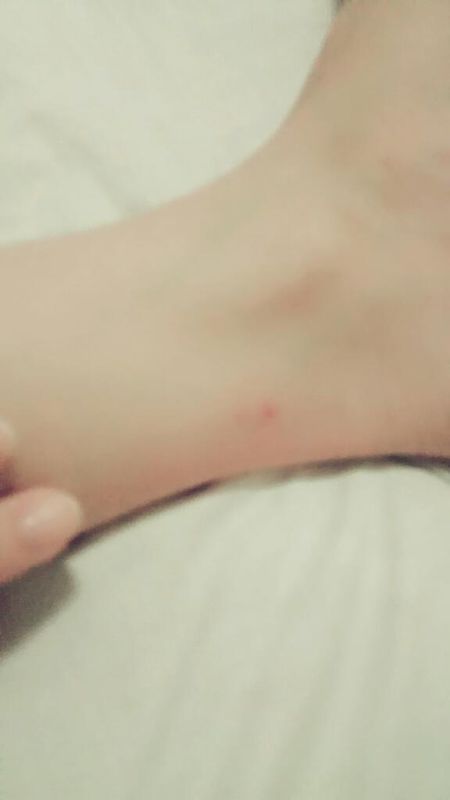 我腿上很多小黑点,去年在老家不知道被蚊子还是跳蚤咬
