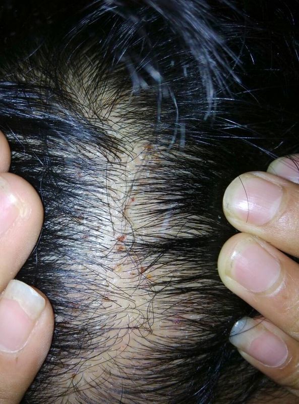 脂溢性皮炎快一年了,头皮最近特别痒,挠了之后结痂.碰