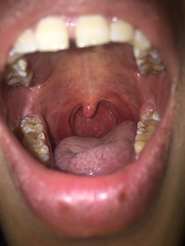 请问我这是不是滤泡咽喉炎 嗓子里面 上牙膛 还有舌苔