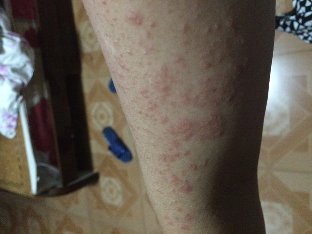 小红点,好痒好痒抓了一下成了红红 疙瘩一样,请问有谁知道这是什么病