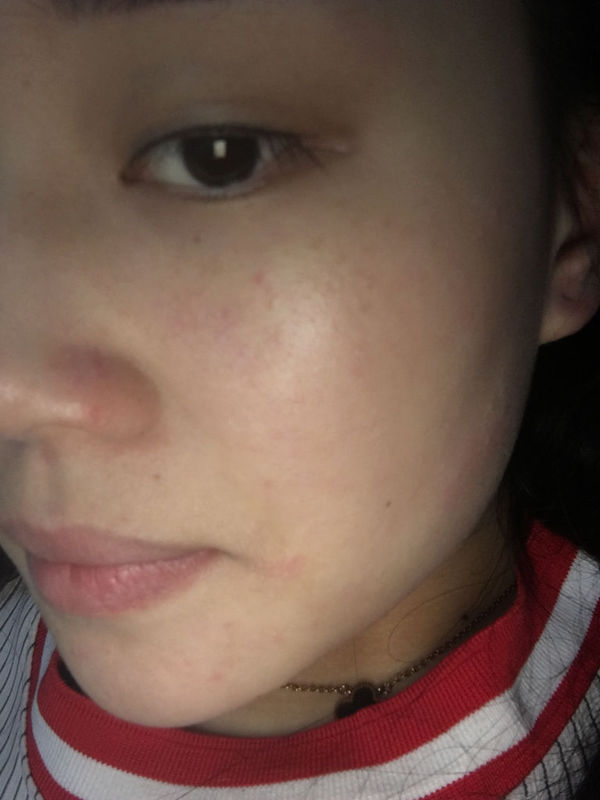 脸部角质层太薄了,有很多红血丝,怎样修复角质层太薄了有 脸一过敏总