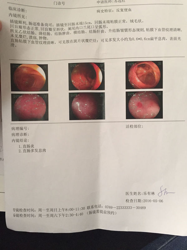 6cm扁平息肉,表面光滑,请问这息肉用不用