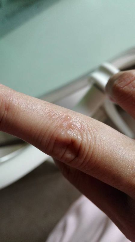 手指上长透明的水泡是得手癣了吗?