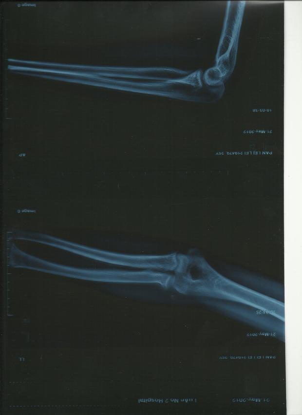 左手桡骨小头骨折 石膏拆完怎么恢复训练