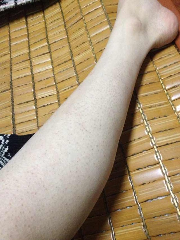 我身上为什么有鸡皮肤 怎么去除呢?