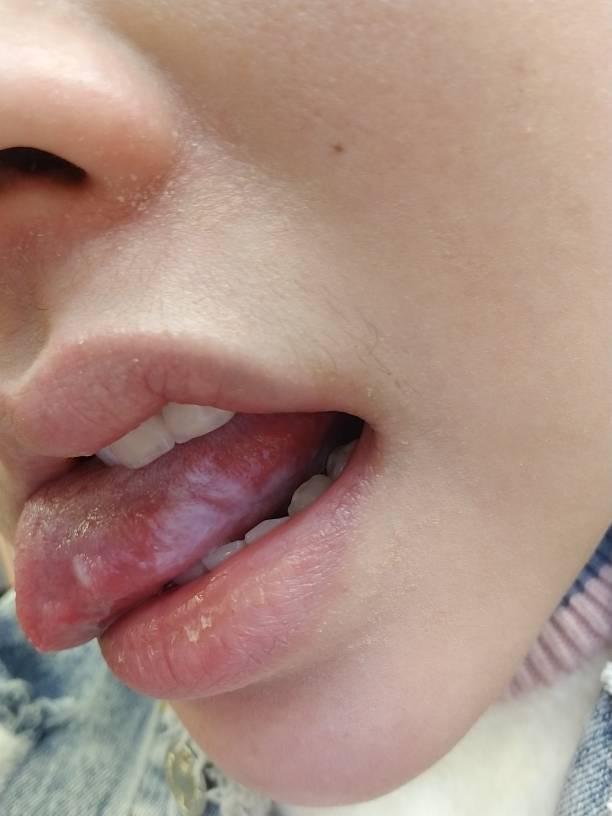 舌头右侧边缘有白色物状,不会疼痛,有谁知道是什么原因吗?