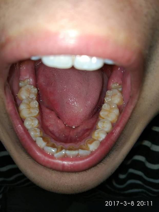 我想请问下我的这下颚两颗智齿是什么类型的智齿呢?是