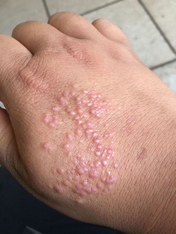 手背起湿疹了,去年开始起一个痘痘,还以为蚊子咬的,挤破之后出水了