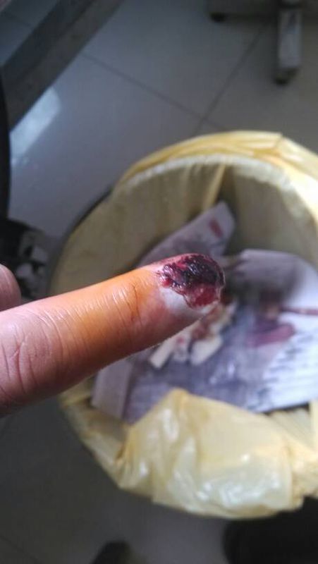 在家具厂上班因机器故障致左手食指被压伤,到医院诊断
