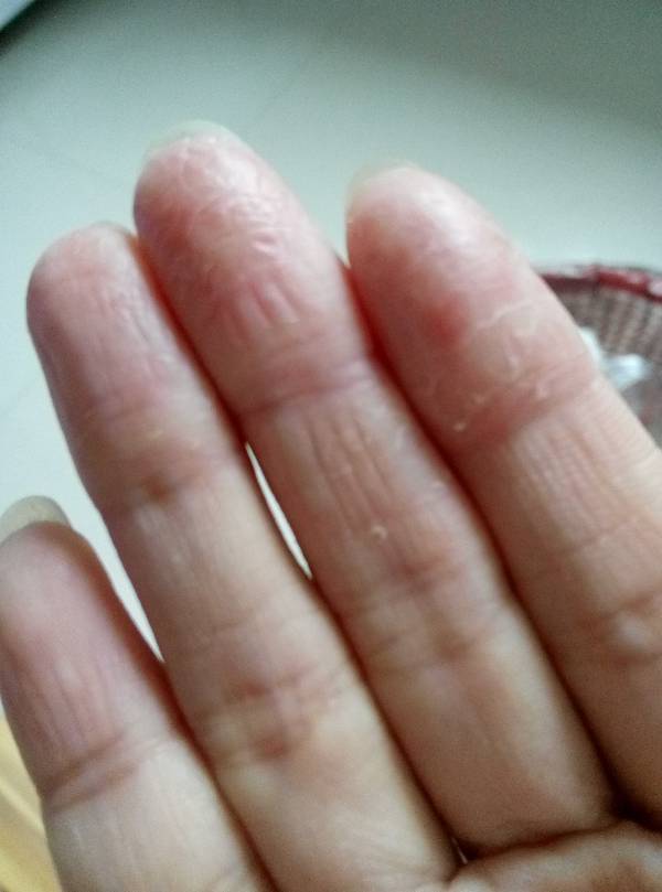 手指脱皮,没有指纹了,好几个月了一直没好,这是什么皮肤病,有人知