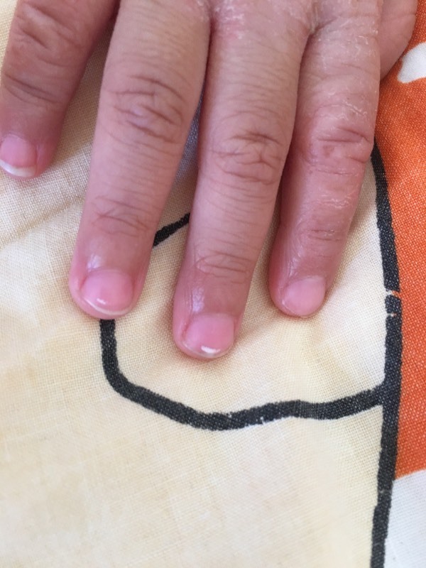 手指甲上白斑(见图)是缺锌还是肚里有虫啊?