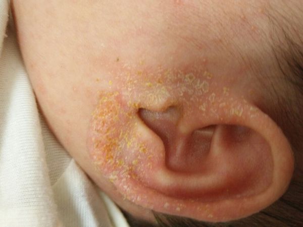 宝宝一个月了脸上头上出了好多红点点 耳朵上还有黄色