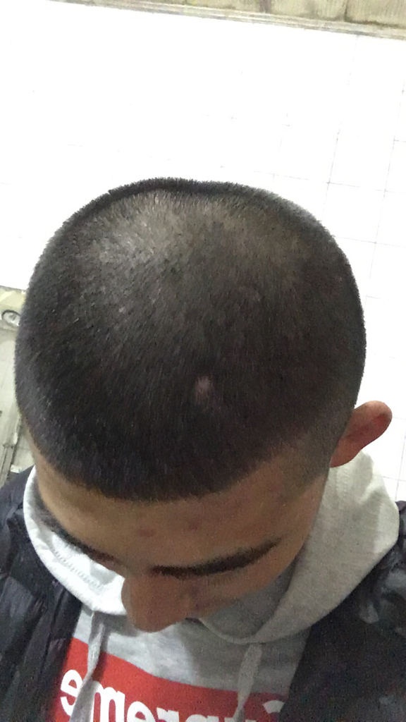 头上长了个痘痘,抠破不长头发了,一个月了,还能长出来