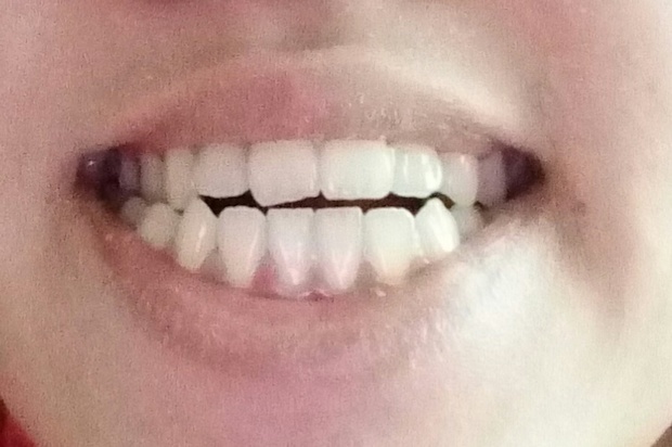 请问我牙齿属于正常吗?