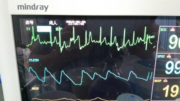 这心电监护仪上的二导联是什么意思?