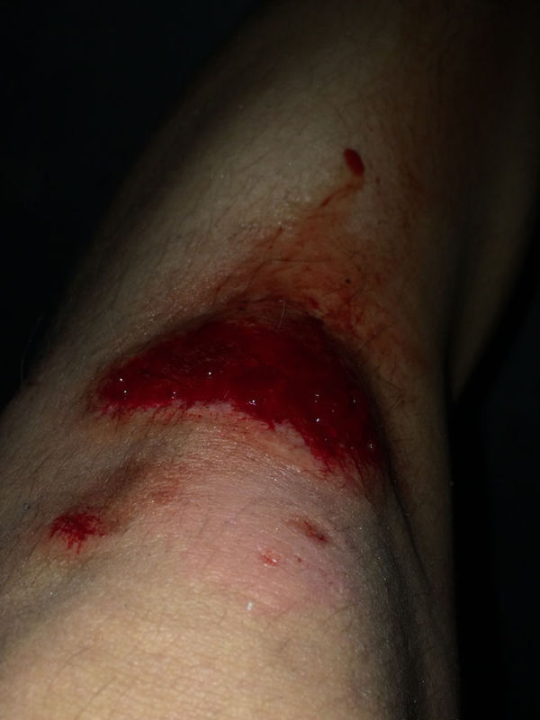 骑山地车遇到大暴雨在柏油马路打滑摔了一跤,膝盖出血