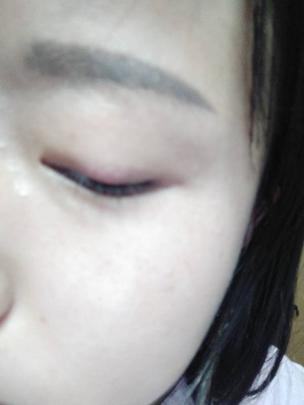 过年期间眼睛上长了个疙瘩 家里人说是撅眼 吃了药 现在都好久了 可用