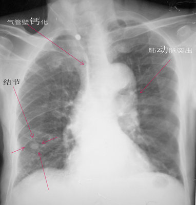右肺下叶胸膜下小结节影,请结合临床随访,这是什么意思?严重吗?