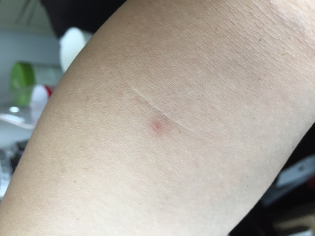 请问这是蜘蛛痣吗?