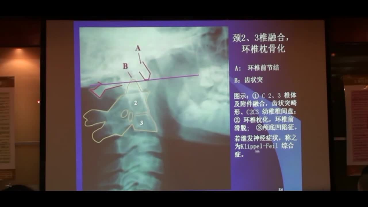 颈椎先天发育畸形能买保险吗 颈椎畸形手术