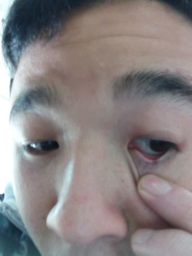 肉痣怎么去除?