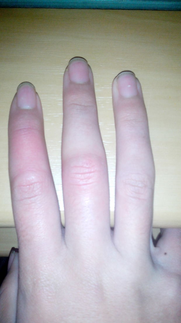 手指关节肿痛怎么办?