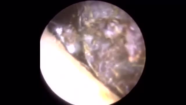 健康天天测 外耳发炎是掏耳屎引起的吗 相关视频 外耳道炎是怎么引起的 爱言情