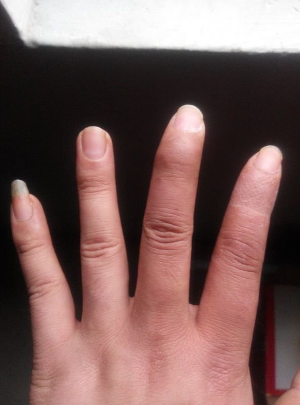 我的左手食指和中指骨折 食指不能弯曲 中节与末节筋断了 麻木无感觉