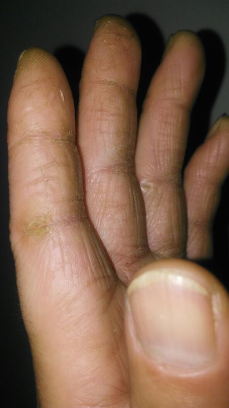 手指经常裂口,皮肤干燥,变硬,而且不分季节(如图),请教专业的网友给