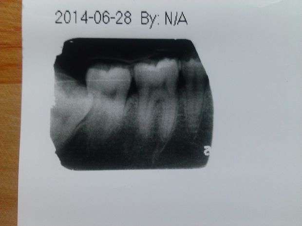 怎么看牙齿的x片,是否需要做根管治疗?