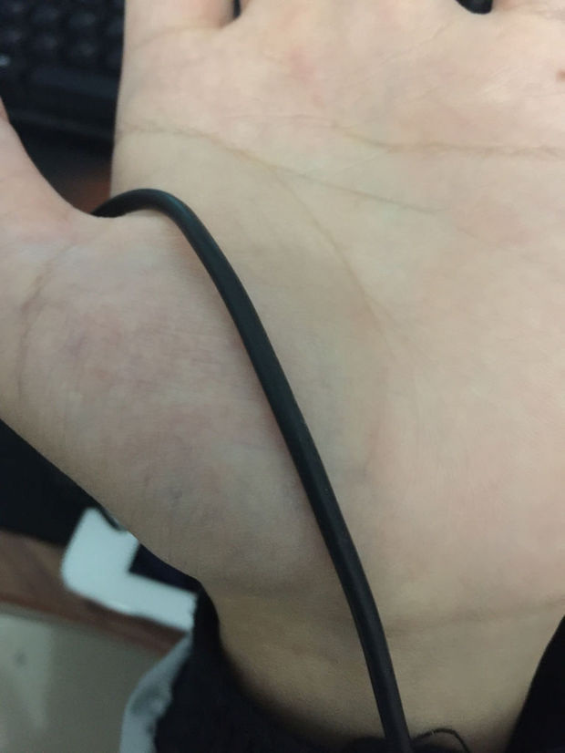 左手掌靠大拇指边有根血管凸起硬硬的 跳动而且有压痛