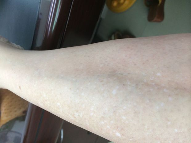小腿及手臂上出现了很多小白斑