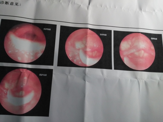 喉镜检查没发现异物,但有刺痛感