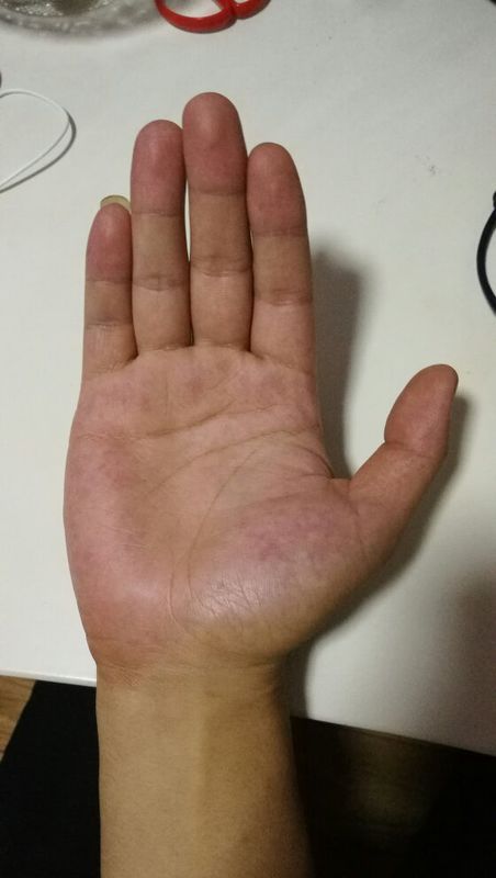 去年体检乙肝五项正常,有抗体,肝功能正常,b超说肝脏回声增强没有增粗