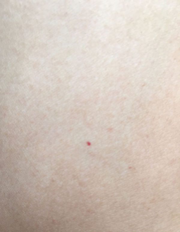 身上胳膊上有很多小血点,不疼不痒,好几年了,小的和针尖,大的有1毫米