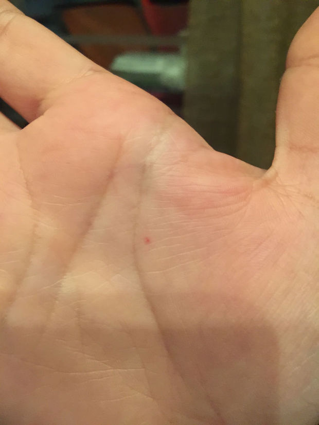 手上有三四个这样的小红点点 不痛不痒 在皮肤里层 按压有点褪色 好像