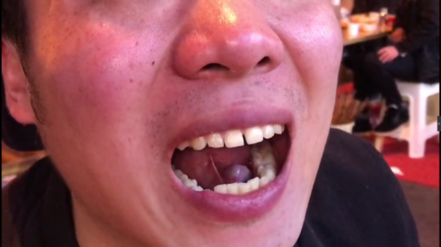 口腔内舌下长了一个黑色包,不痛不痒,只有一点点异物感.这是什么?