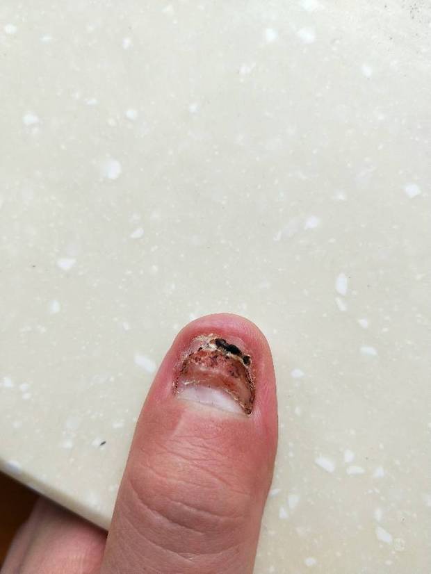 手指甲被车门夹过手指淤血变黑,后来没有放血处理,现在指甲片掉了